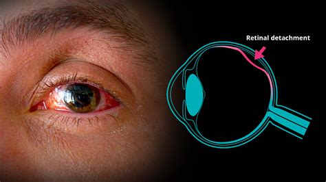 Retinal Detachment Symptoms
