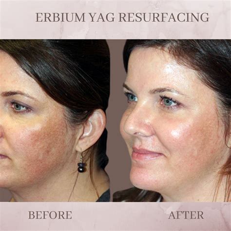 Erbium Skin Resurfacing - Eluma - Laser & Aesthetics