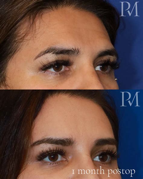 Prominent Brow Ridge Reduction