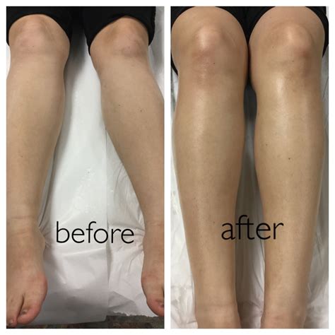 Strawberry Legs Before And After Laser Hair Removal at Brian Bauer blog