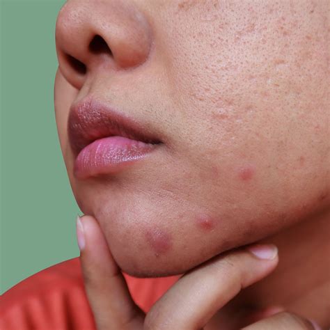 Hormonal Acne Around Mouth