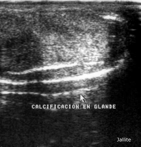 Enfermedad de Peyronie