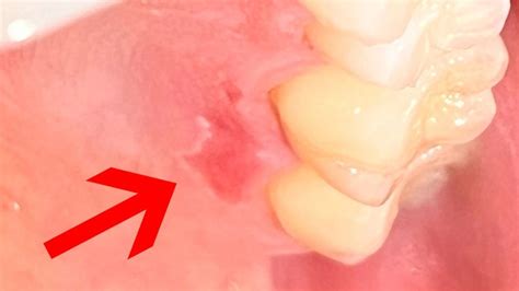 Peeling Of Inside Of Mouth - What You Need To Know