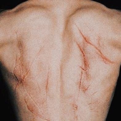 19 people who survived getting struck by lightning show what it does to ...