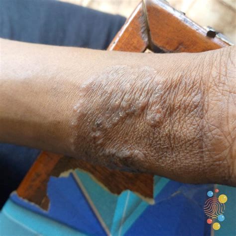 Tinea corporis - Skin Deep