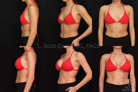 Breast Augmentation Surgery in Miami at Four Seasons | BECA