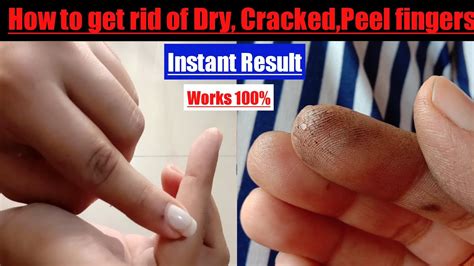 How to get rid of Dry,Rough,Crack,Peeled fingers|Overnight Proper ...