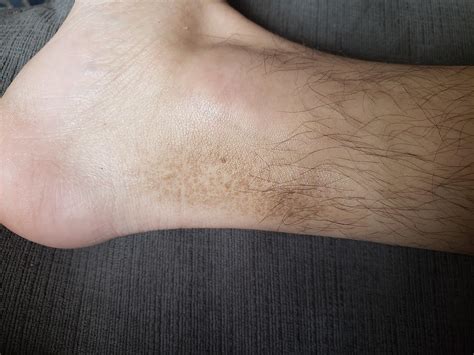 Are these brown spots something serious? Appeared only on one side of one ankle about a month ...