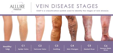 Classification of Venous Disease