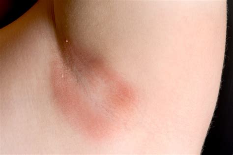 DermDx: Moderately Itchy Underarm Rash - Dermatology Advisor