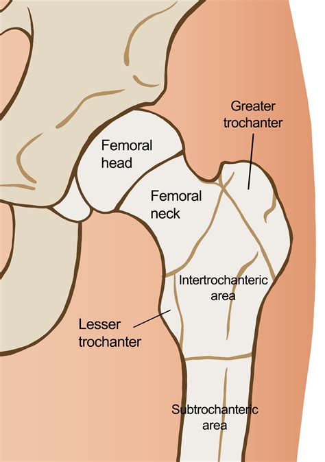 Intertrochanteric Fracture Vs Femoral Neck Fracture