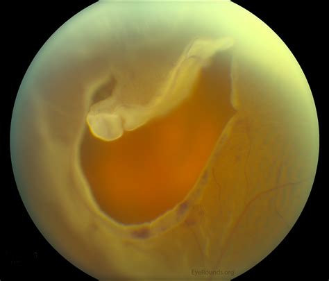 Horseshoe Retinal Tear