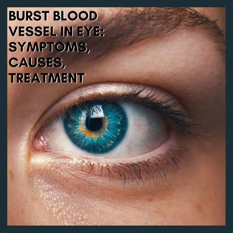 Broken Blood Vessel In Eye – Subconjunctival Hemorrhage: Symptoms ...