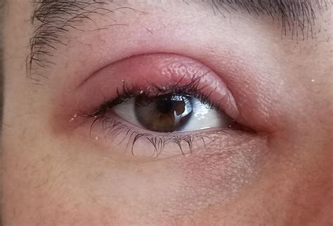 Stye Upper Eyelid Swollen