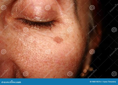 Brown Spots Under the Eye. Pigmentation on the Face Stock Photo - Image of mark, medicine: 98819076