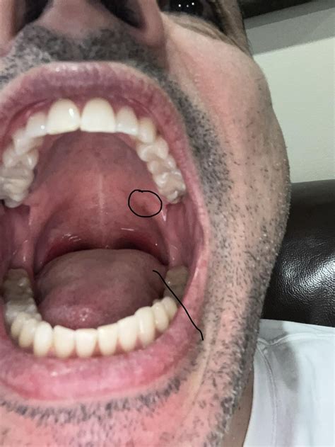 Swollen bump on soft palate : r/askdentists