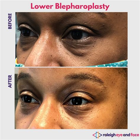 Lower Lid Blepharoplasty