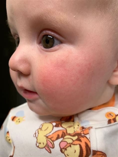 Baby Rash On Face Allergy