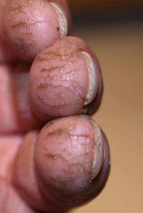 How to Prevent and Treat Cracked Fingers and Fingertips - HubPages