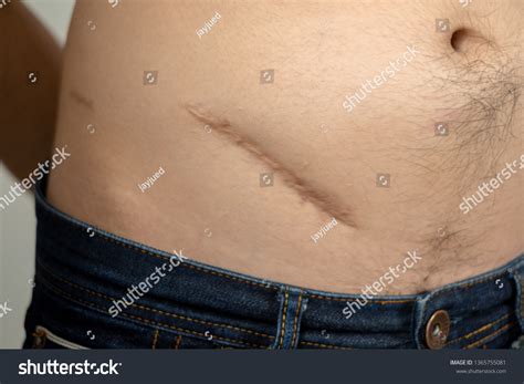Appendix Surgery Scar: Over 320 Royalty-Free Licensable Stock Photos | Shutterstock