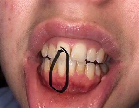 Concerned my teeth will fall out.. concerned about the red patch there ...