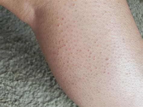 Bumpy Legs Causes Of Red Bumps And Spots On Legs