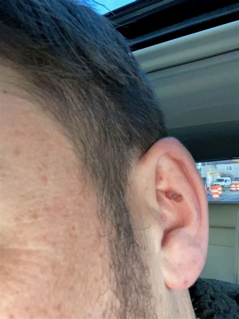 Lump Behind Ear Lymphoma