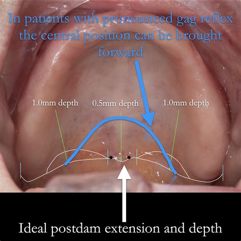 Palatal Reflex Vs Gag Reflex at Katie Jenkins blog