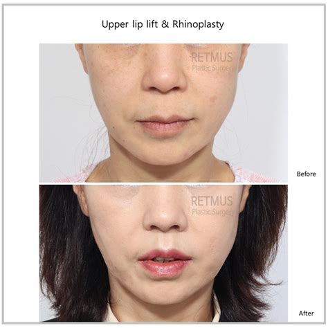 lip lift before and after - Retmus Plastic Surgery 리트머스성형외과 on Instagram: " Upper lip lift ...