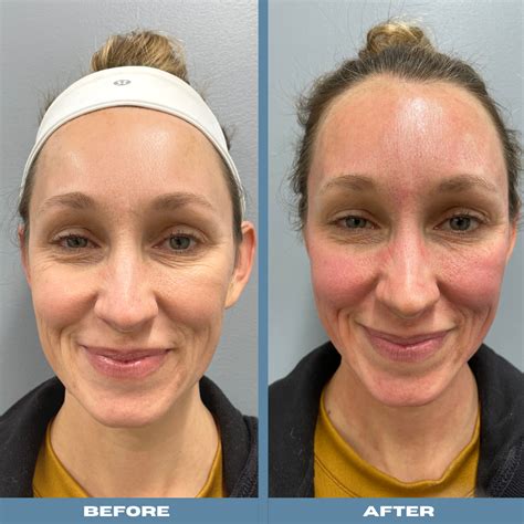 My Microneedling Real Life Before and After Experience - Cornerstone Dermatology & Surgery Group