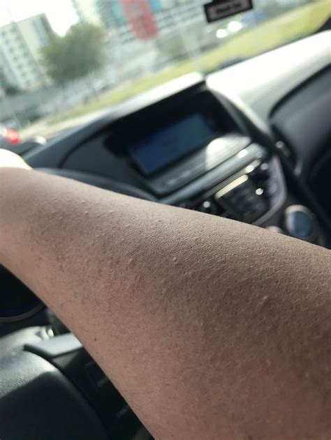 Itchy Bumps On Arms