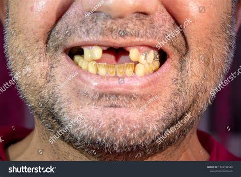 Toothless Hillbilly Smile