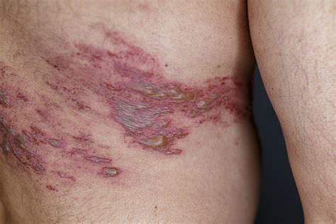 Herpes Zoster Shingles Virus