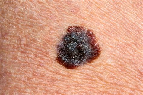 Stage 3 Malignant Melanoma