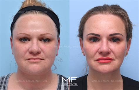 How Fillers Shape Your Best Face Before and After Weight Loss – Mabrie Facial Institute