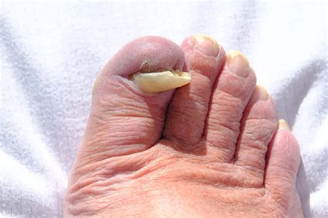 Toenail Lifted But Still Attached - What Should I Do?