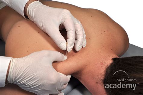 Dry Needling - Precise, Safe and Effective