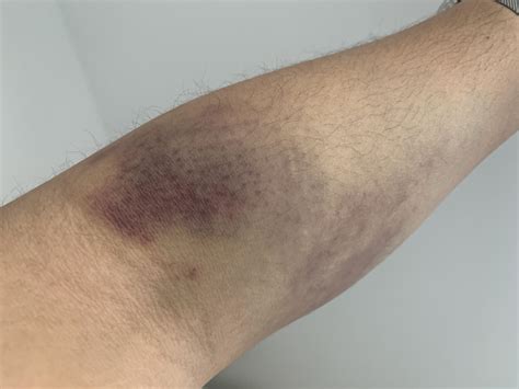 Blood Donation Bruises