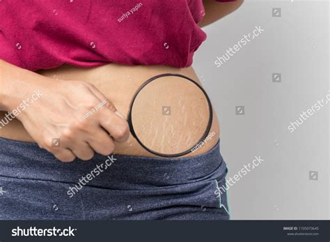 10,185 Stretch Mark Background Images, Stock Photos & Vectors ...