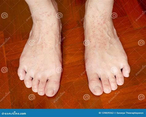 Shower Rash Feet at Richard Armes blog