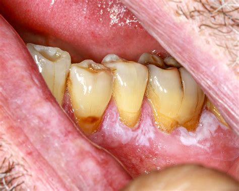 Proliferative Verrucous Leukoplakia
