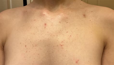 Pimple On Chest