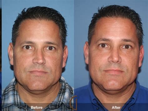 Pics Of Broken Noses