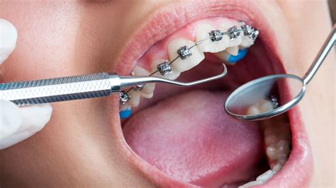 Orthodontics Dentistry and All Information about it | Healing Clinic Turkey