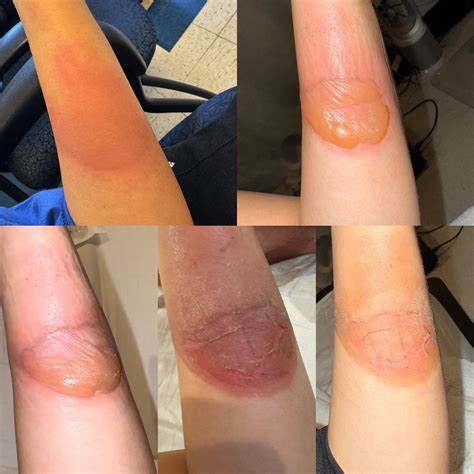 1st Degree Burns First Aid Management: Burns And Frostbite ! Public