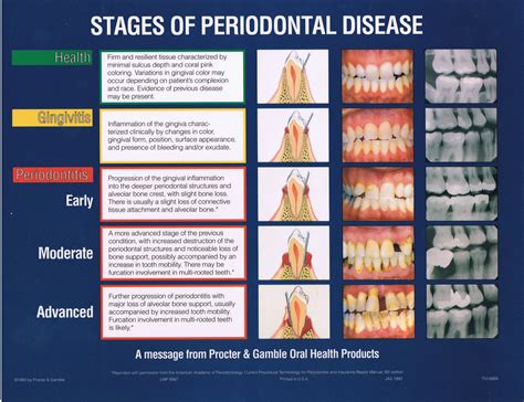 Stages of periodontal disease. #dentistry | Dental hygiene school ...