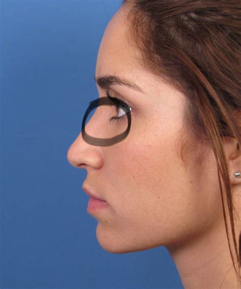 Bridge Of Nose Muscle Twitching - mapasgmaes