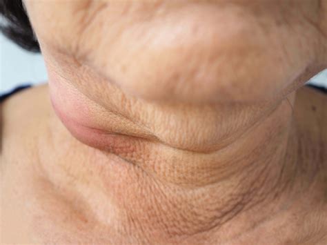 Can Cervical Cancer Cause Swollen Lymph Nodes In Neck - Infoupdate.org