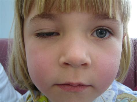 Ptosis | 5.4 | Westmead Eye Manual