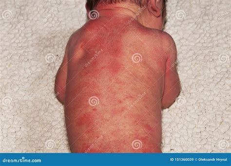 Severe Baby Acne Chest at Amanda Hackler blog